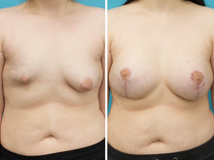 TUBEROUS BREAST - Implant: 4200cc/555cc