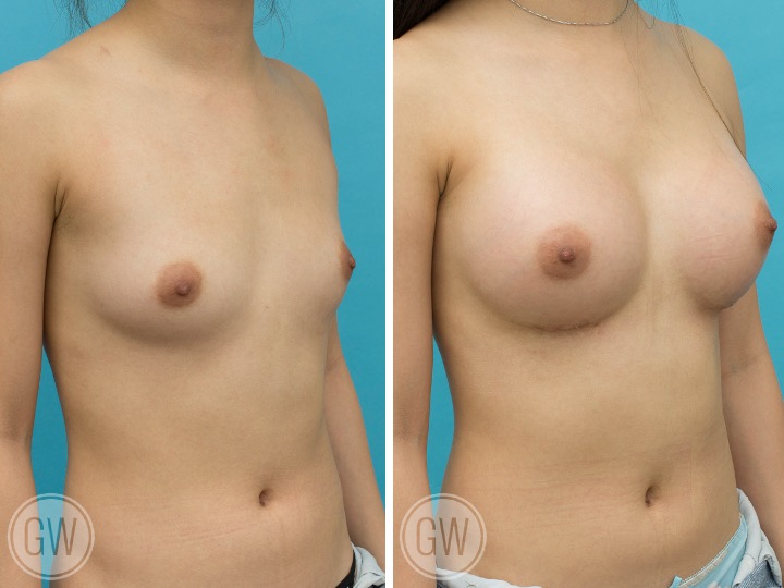 300cc/275cc Implant: Left – 300cc Smooth Round, Moderate Plus Profile, Right – 275cc Smooth Round, Moderate Plus Profile
