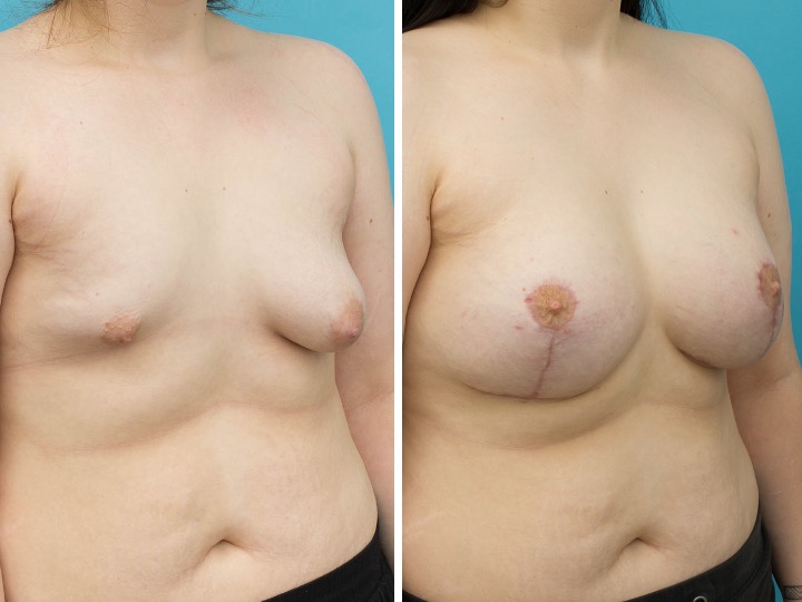 420cc/555cc Implant: Left - 420cc Anatomical, Medium Height, Moderate Plus Profile, Right - 555cc Anatomical, Medium Height, High Profile