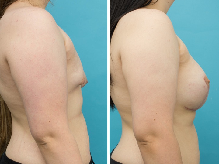 420cc/555cc Implant: Left - 420cc Anatomical, Medium Height, Moderate Plus Profile, Right - 555cc Anatomical, Medium Height, High Profile
