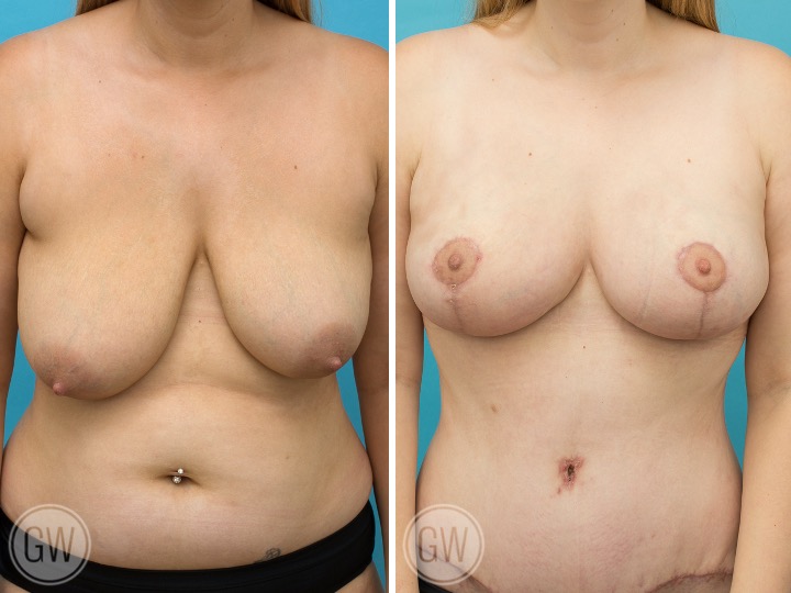 BREAST RESHAPING WITH FAT GRAFTING- Breast Lift