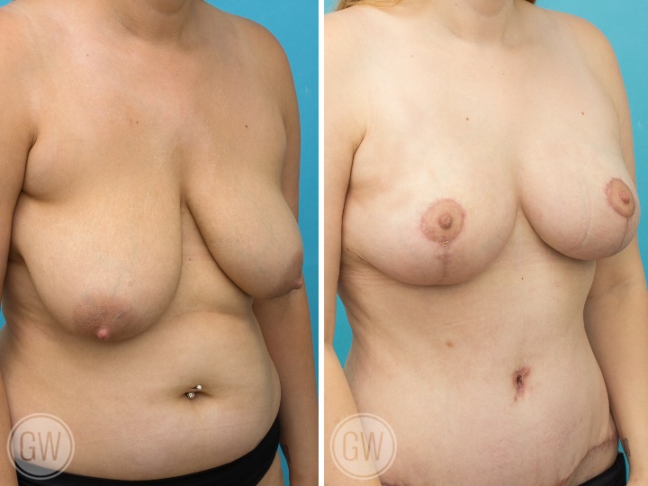 Breast Lift Breast Lift: Fat Grafting 200cc Per Side