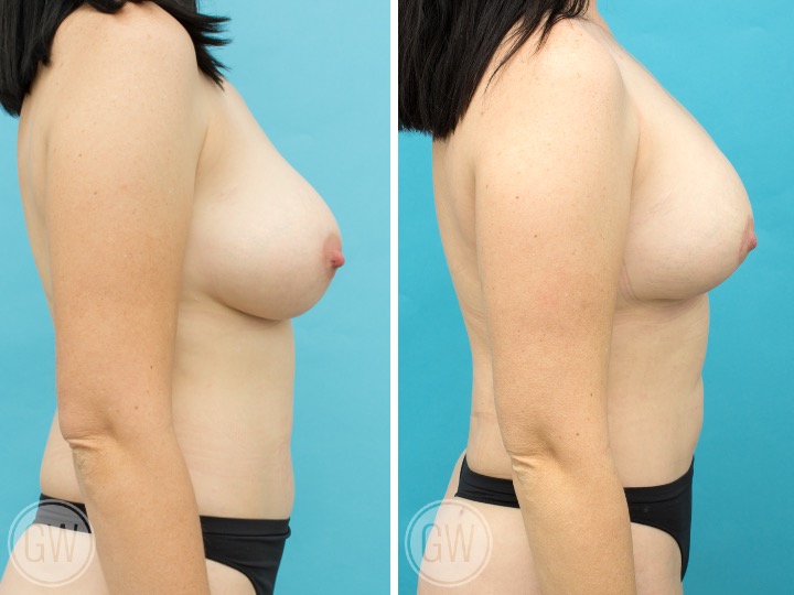 280cc Implant: 280cc Anatomical, Medium Height, Moderate Projection