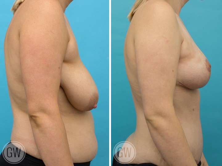 Breast Lift Breast Lift: Fat Grafting 200cc Per Side