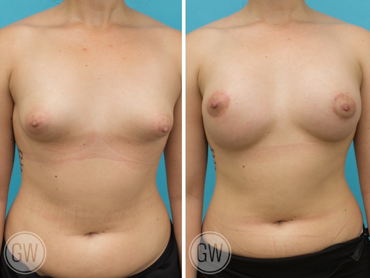 BREAST RESHAPING WITH FAT GRAFTING- Implant: 375cc 