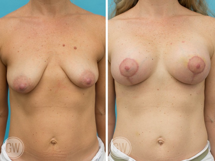 BREAST LIFT AND IMPLANTS -Implant: 375cc
