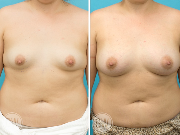 BREAST RESHAPING WITH FAT GRAFTING- Implant: 415cc 