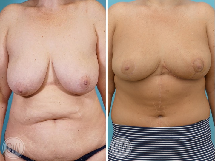 Breast Reduction and Lift Gallery Before and After Photos - Dr Guy Watts Plastic Surgeon