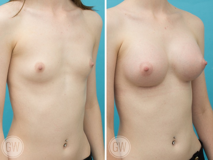 300cc Implant: 300cc Smooth Round, Demi Profile