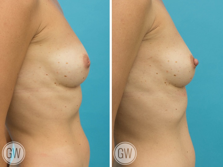 Inverted Nipple Correction Inverted Nipple Correction