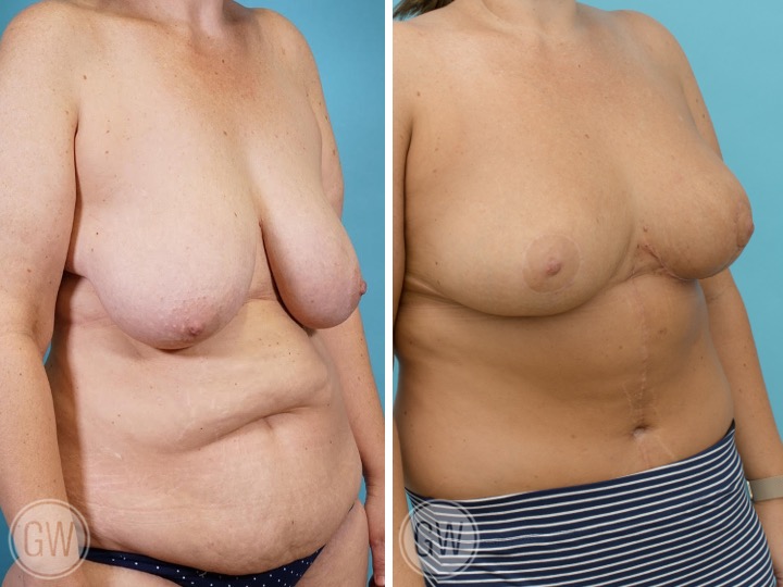500cc Breast Reduction: 500cc Gland Removal per side
