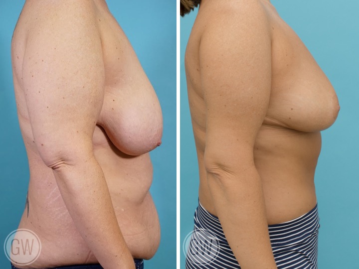 500cc Breast Reduction: 500cc Gland Removal per side
