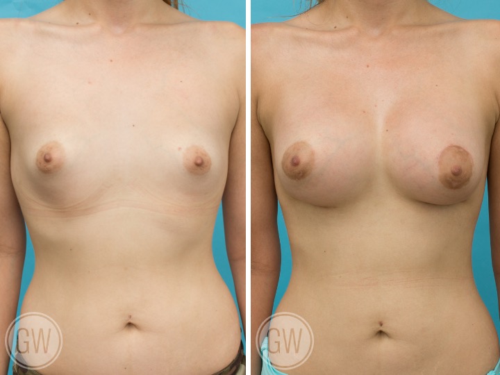 BREAST RESHAPING WITH FAT GRAFTING- Implant: 395cc 