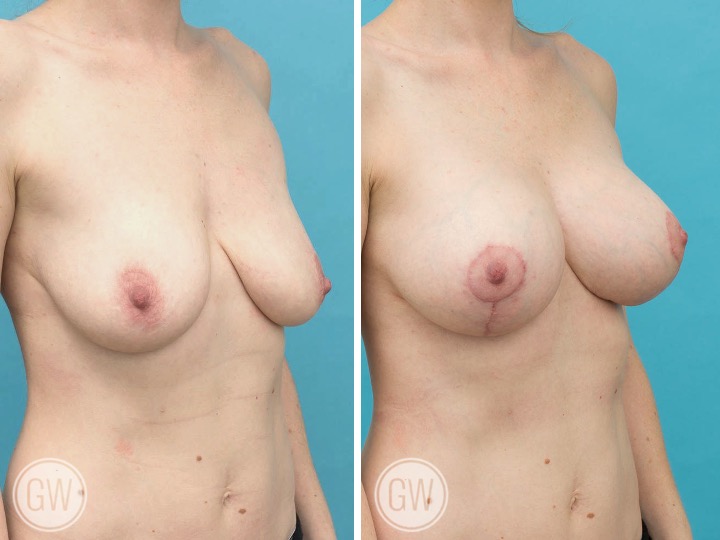 250cc/275cc Implant: Left- 250cc Smooth Round, Moderate Plus Profile. Right- 275cc, Smooth Round, Moderate Plus Profile