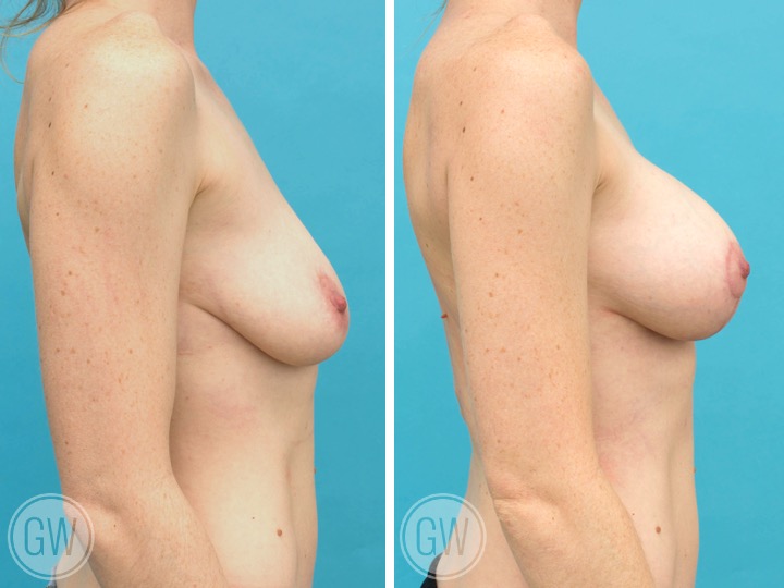 250cc/275cc Implant: Left- 250cc Smooth Round, Moderate Plus Profile. Right- 275cc, Smooth Round, Moderate Plus Profile