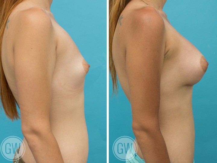 395cc Implant: 395cc Anatomical, Tall Height, Moderate Plus Profile