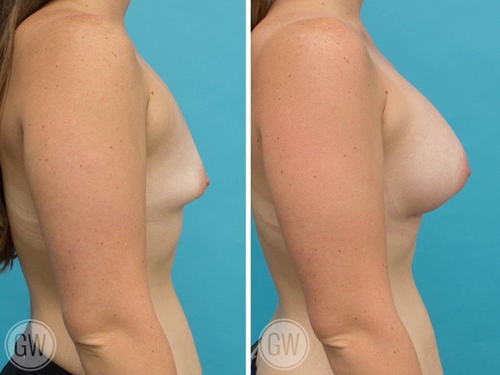 395cc Implant: 395cc Anatomical, Tall Height, Moderate Plus Profile