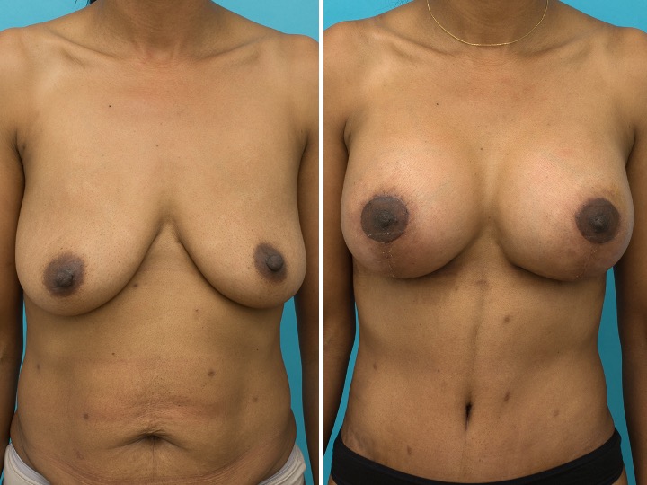 BREAST LIFT AND IMPLANTS -Implant: 375cc/400cc