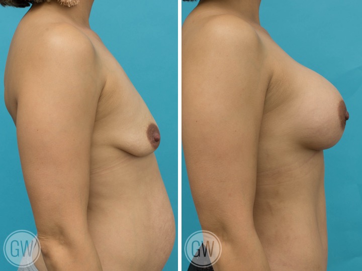 350cc Implant: 350cc Textured Round, High Profile
