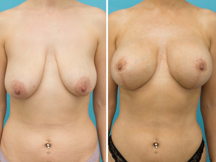 BREAST LIFT AND IMPLANTS -Implant: 500cc