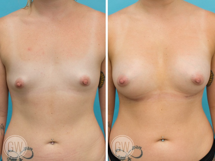 TUBEROUS BREAST - Implant: 395cc