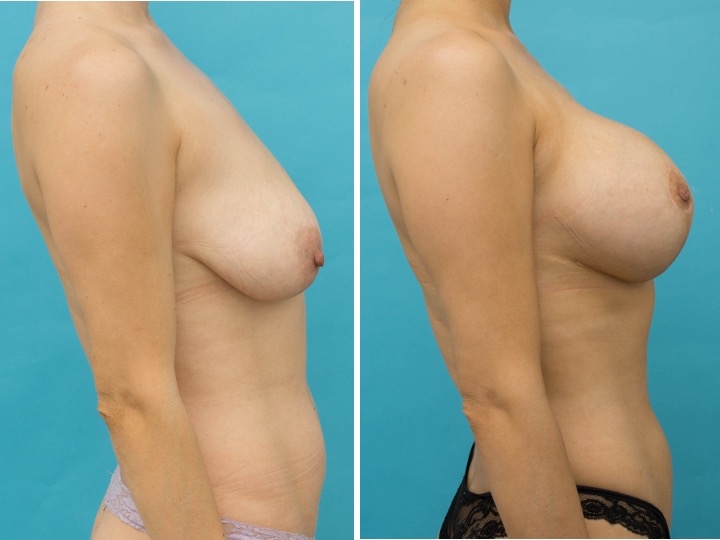 500cc Implant: 500cc Textured Round, High profile,