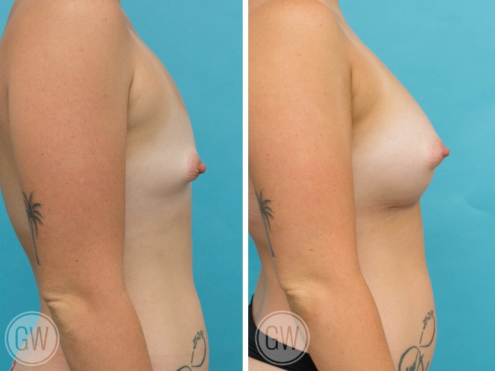 395cc Implant: 395cc Tall Height, Moderate Plus Profile