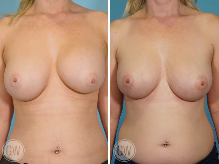 Breast Implants Revision Before and After Photos - Dr Guy Watts Perth WA