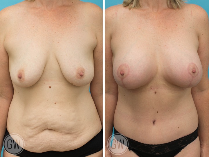 BREAST LIFT AND IMPLANTS- Implant: 450cc