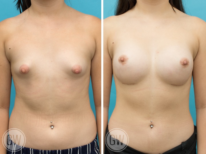 BREAST RESHAPING WITH FAT GRAFTING- Implant: 300cc