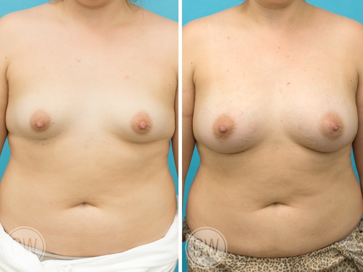 TUBEROUS BREAST - Implant: 415cc