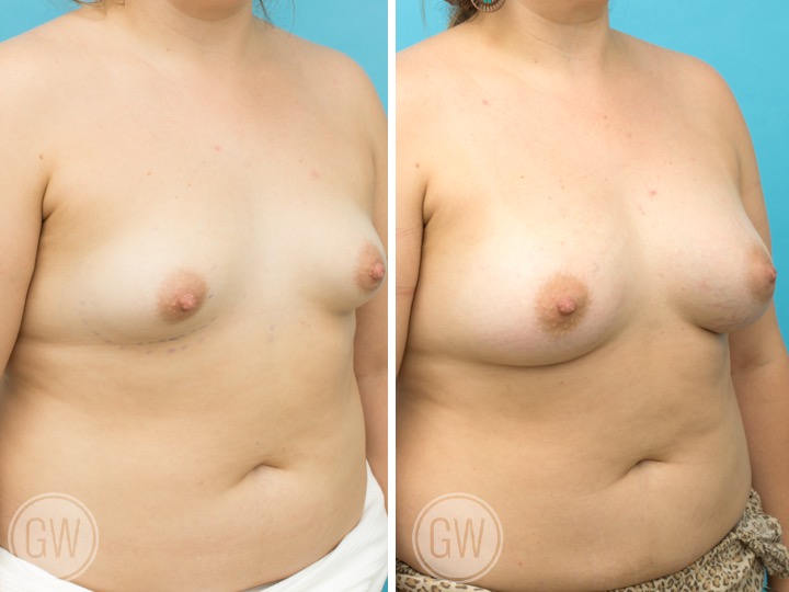 415cc Implant: 415cc Anatomical, Low Height, Moderate Profile + 50cc Fat Grafting per side