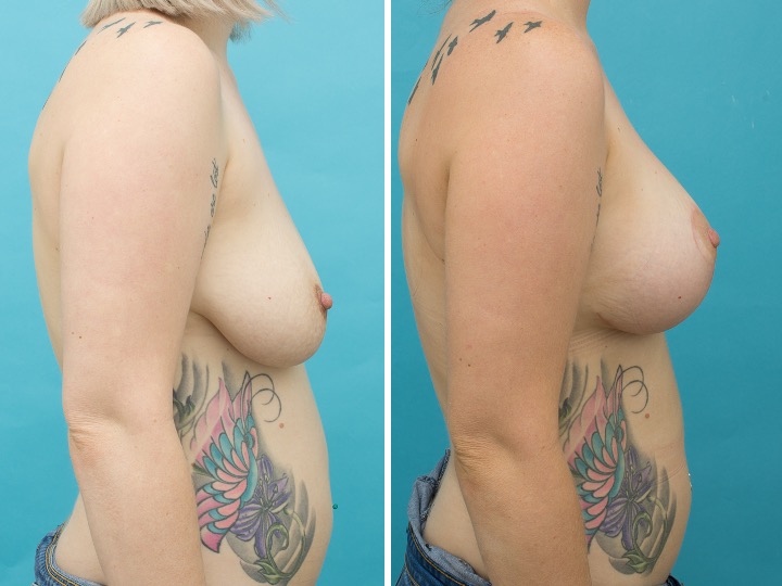 350cc Implant: 350cc Smooth Round, Moderate Plus Profile