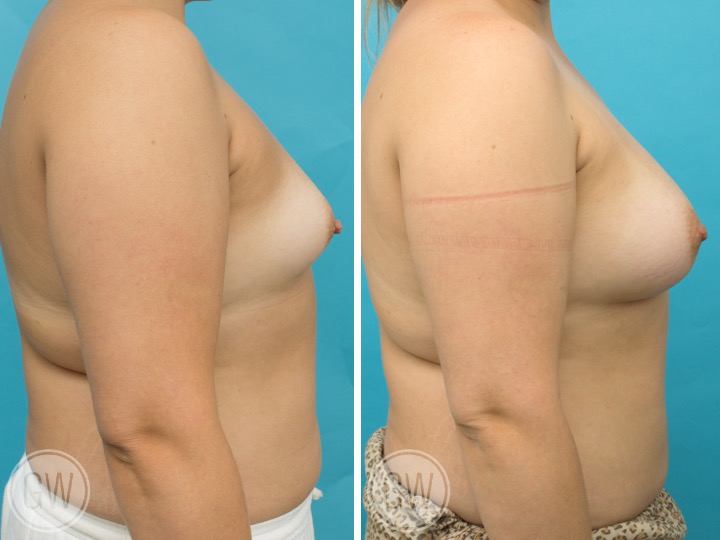 415cc Implant: 415cc Anatomical, Low Height, Moderate Profile + 50cc Fat Grafting per side