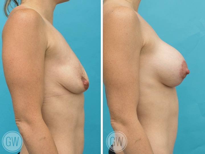 350cc Implant: 350cc Smooth Round, High Profile