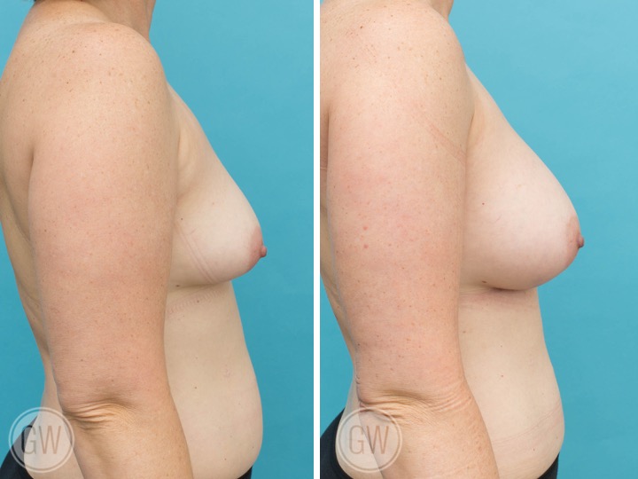 375cc Implant: 375cc Textured Round, Moderate Plus Profile