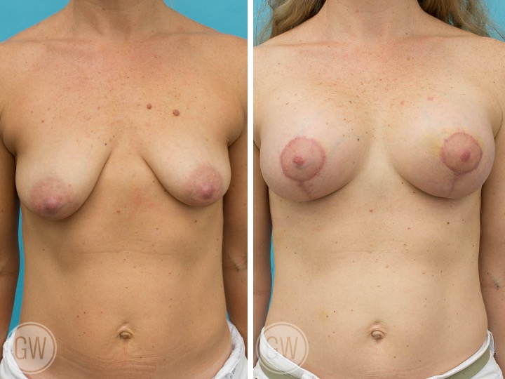 BREAST ASYMMETRY - Implant: 375cc