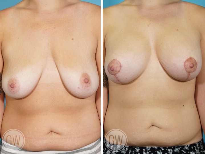 BREAST LIFT AND IMPLANTS -Implant: 350cc