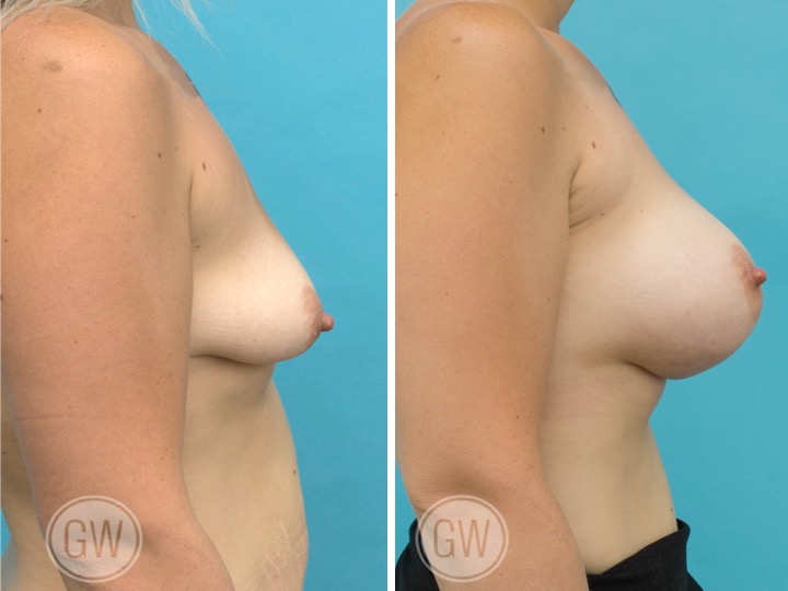 440cc Implant: 440cc Anatomical, Medium Height, High Profile