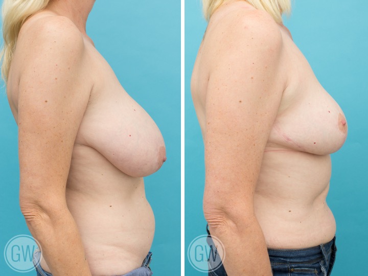 550cc/450cc Reduction: Right 550cc Gland Removal – Left 450cc Gland Removal