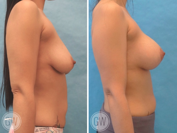 250cc Implant: 250cc Smooth Round, Moderate Plus Profile