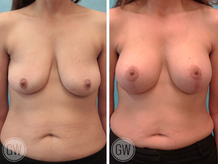 BREAST LIFT AND IMPLANTS -Implant: 300cc