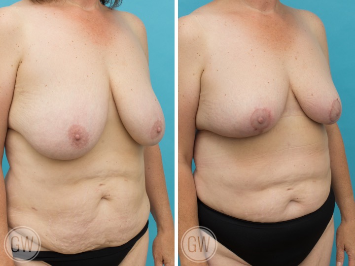 500cc/425cc Reduction: Right 500cc Gland Removal – Left 425cc Gland Removal