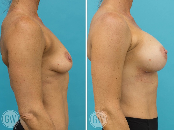 375cc Implant: 375cc Smooth Round, High Profile