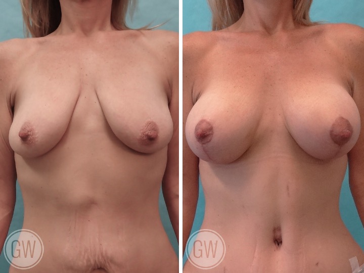 BREAST LIFT AND IMPLANTS -Implant: 350cc