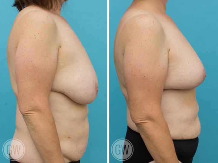 500cc/425cc Reduction: Right 500cc Gland Removal – Left 425cc Gland Removal