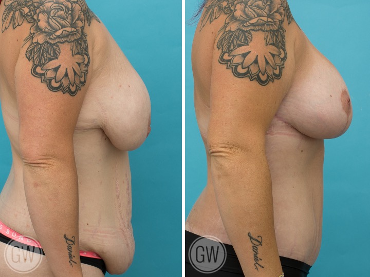 Breast Lift