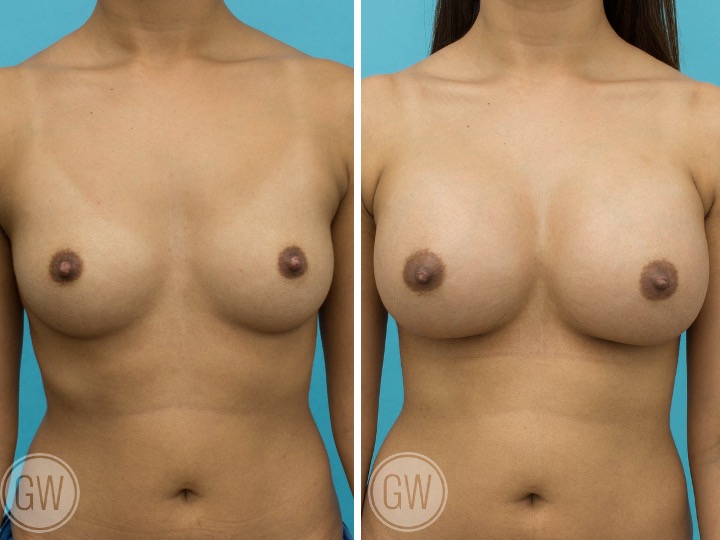 ASIAN BREAST IMPLANTS - Implant: 300cc