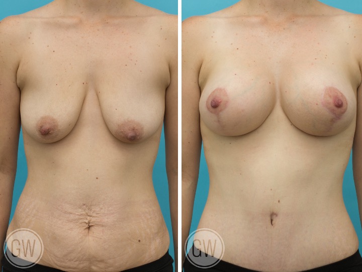 BREAST LIFT AND IMPLANTS- Implant: 330cc