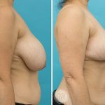 Reduction: Right 400cc Gland Removal – Left 350cc Gland Removal